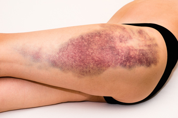 Is arnica good for bruises